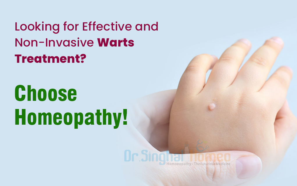Why Choose Homeopathic Treatment for Warts of Different Types? Wart Homeopathic Medicine