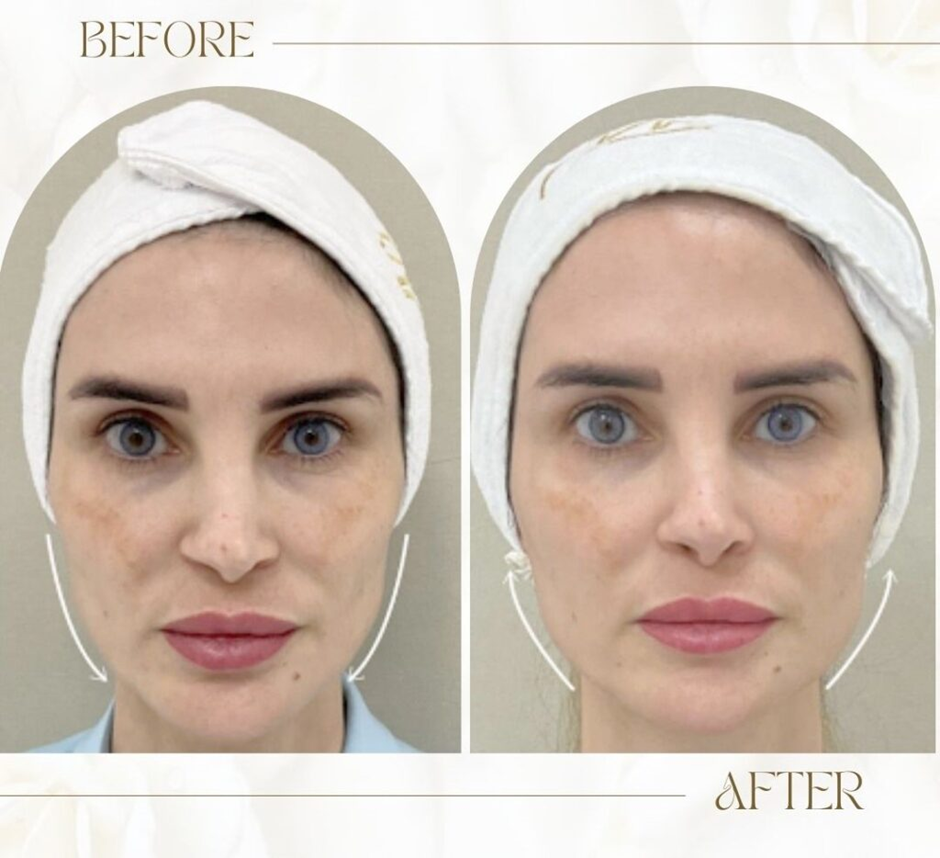The Benefits of Sculptra for Facial Volume Loss The Benefits of Sculptra for Facial Volume Loss