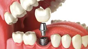 Bring Back Your Smile Confidence with Dental Implants in Brisbane