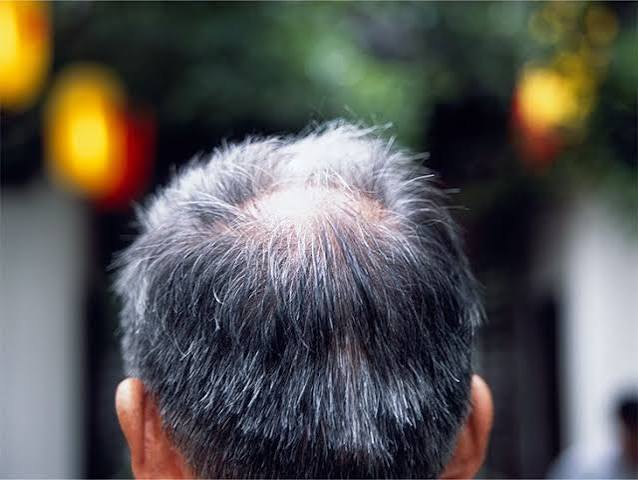 Top 10 Causes of Hair Fall You Should Know